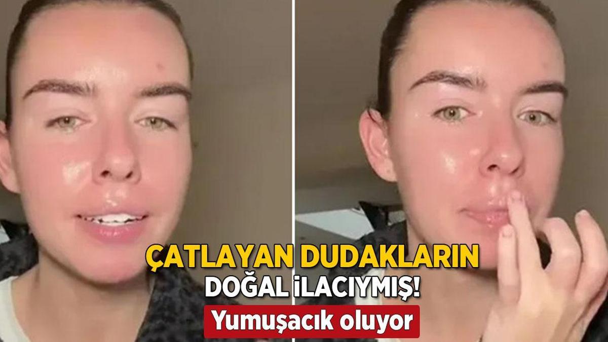 Çatlamış dudaklara pişik kremi tüyosu! Boşuna para dökmeyin, 1 gecede çözüyor
