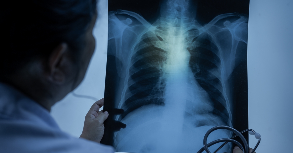 Kanser yükü artıyor! 2050’de vaka sayısı ikiye katlanabilir